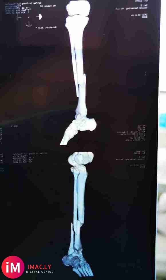 胫腓骨10月16日骨折(图一)10月27日手术后片(图二、三-1.jpg