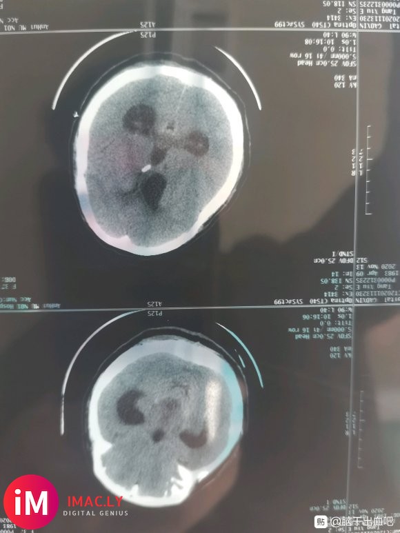 本人老婆因10月16日突发小脑出血20ML入院手术急救,因为-1.jpg