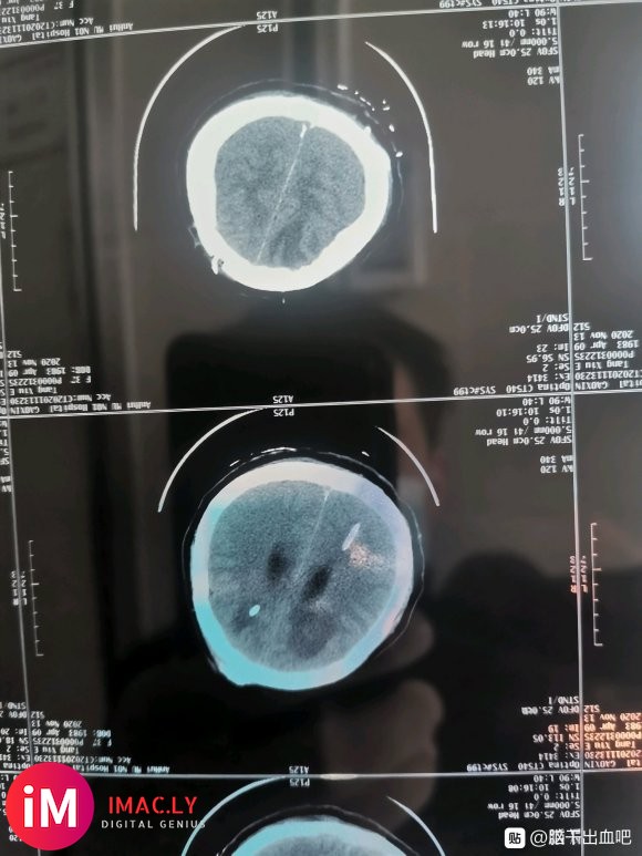 本人老婆因10月16日突发小脑出血20ML入院手术急救,因为-6.jpg
