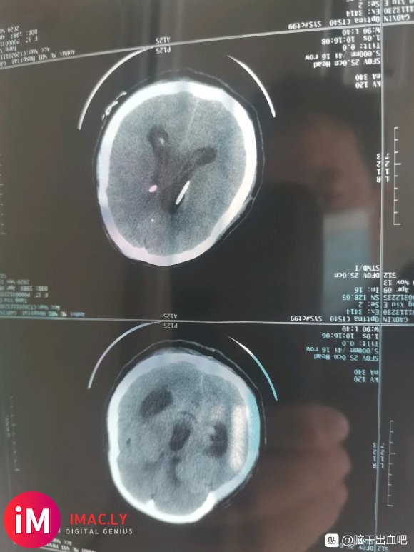 本人老婆因10月16日突发小脑出血20ML入院手术急救,因为-7.jpg