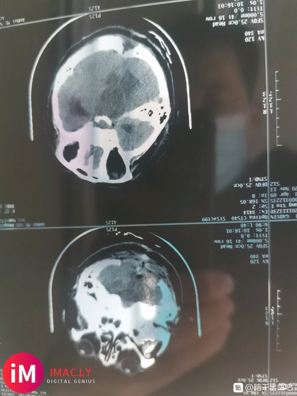 本人老婆因10月16日突发小脑出血20ML入院手术急救,因为-8.jpg