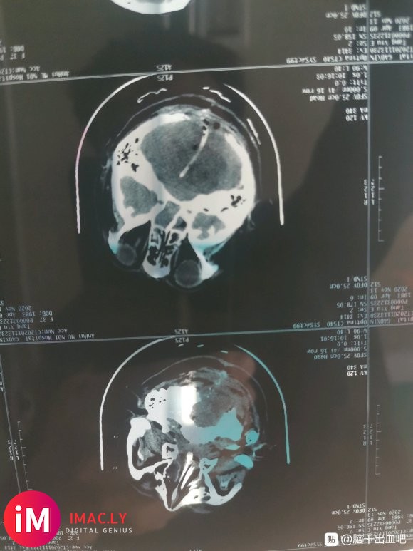 本人老婆因10月16日突发小脑出血20ML入院手术急救,因为-2.jpg