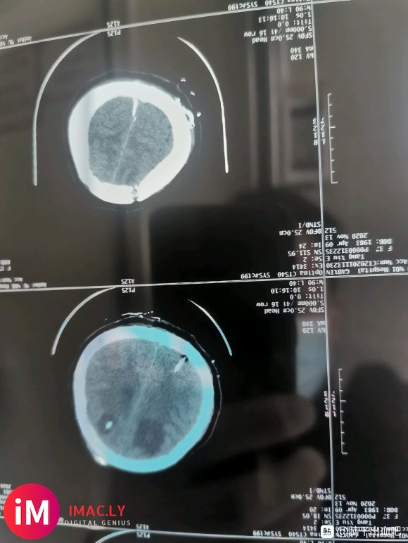 本人老婆因10月16日突发小脑出血20ML入院手术急救,因为-3.jpg