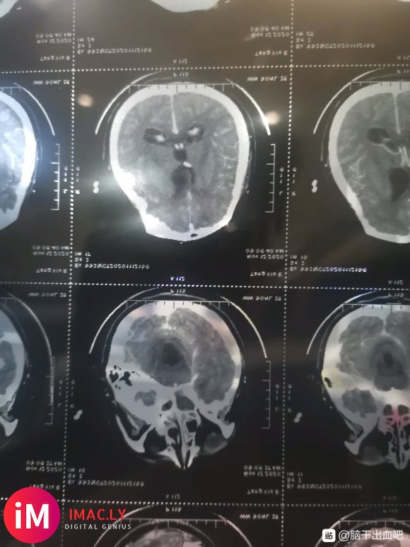 本人老婆因10月16日突发小脑出血20ML入院手术急救,因为-4.jpg
