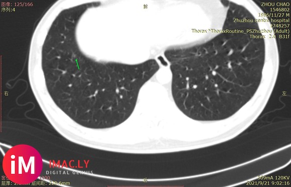 21.9.25问诊  多发性磨玻璃结节(大11.4*7.1), 湖南益阳34岁n-3.jpg