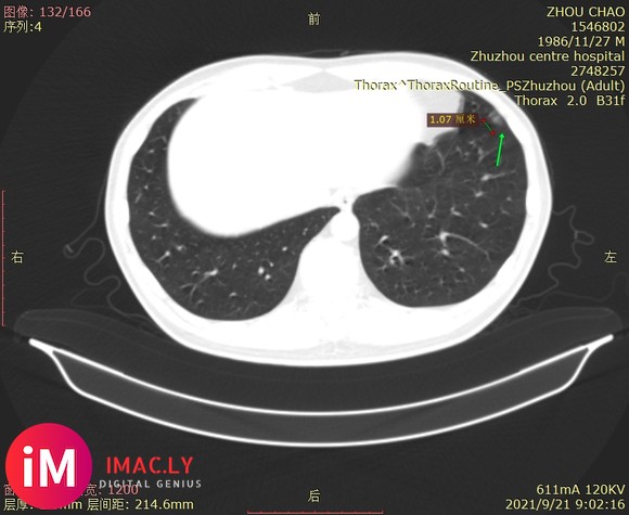 21.9.25问诊  多发性磨玻璃结节(大11.4*7.1), 湖南益阳34岁n-7.jpg