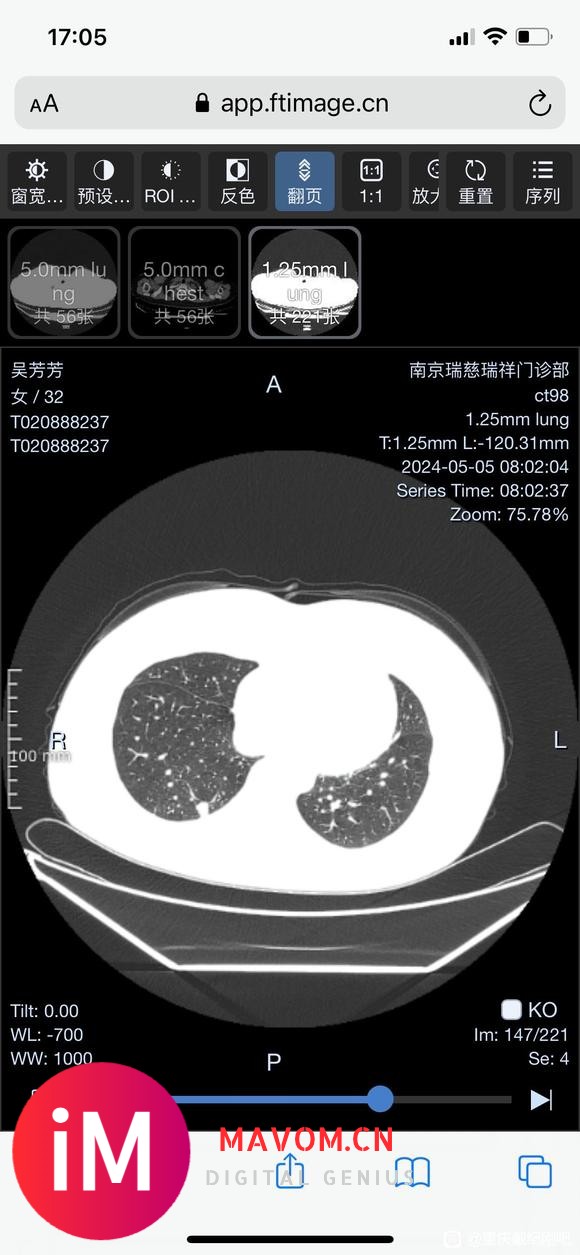 宝妈求助：做完磨玻璃又发现实性结节，请戴主任帮忙看看-6.jpg