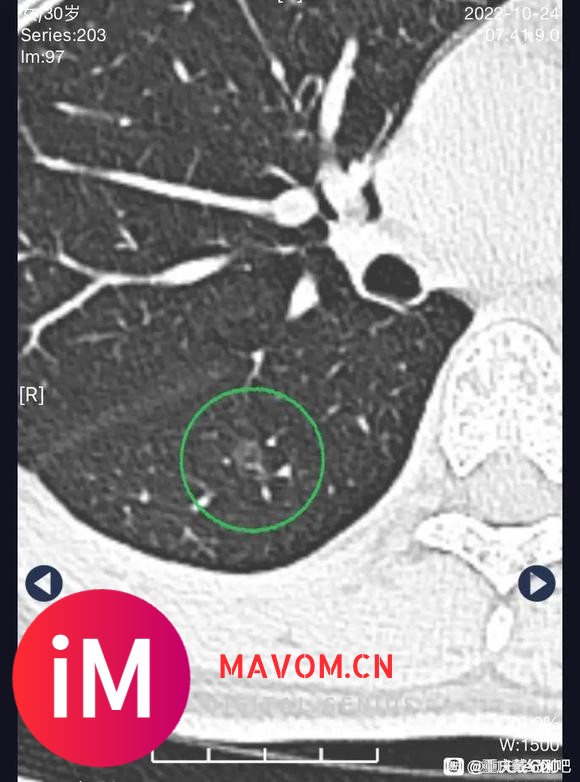 宝妈求助：做完磨玻璃又发现实性结节，请戴主任帮忙看看-2.jpg