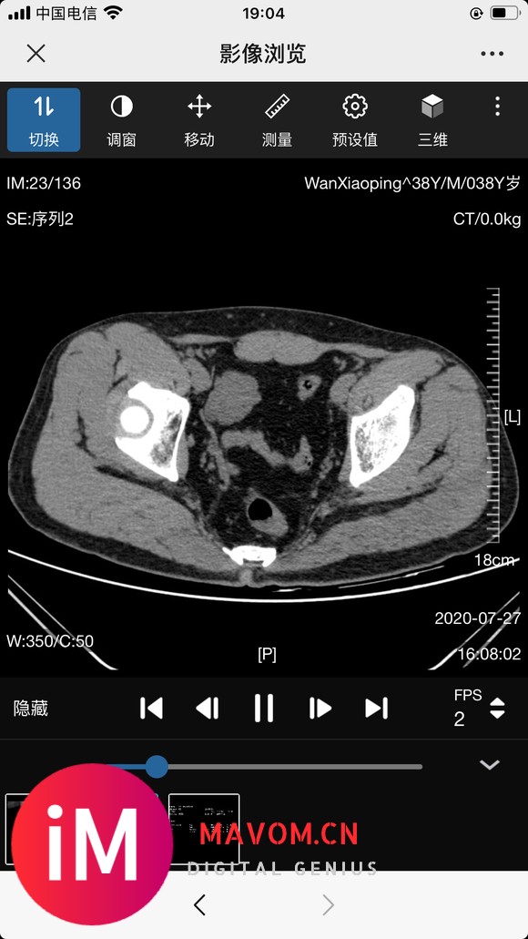 请教:股骨颈置换手术该注意些什么?-1.jpg