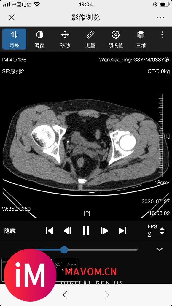 请教:股骨颈置换手术该注意些什么?-2.jpg