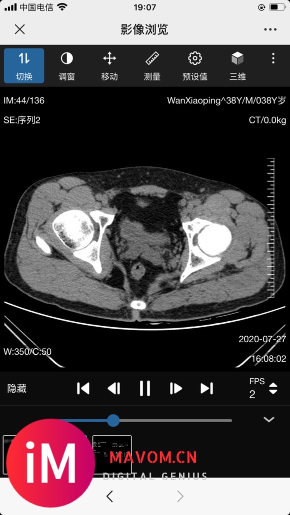 请教:股骨颈置换手术该注意些什么?-3.jpg