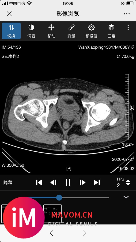 请教:股骨颈置换手术该注意些什么?-4.jpg