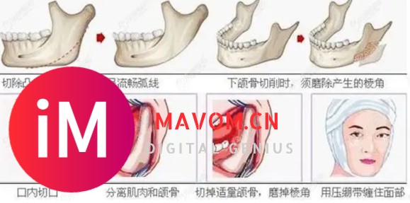 爱美必看：削骨和磨骨哪个更安全？削骨前后对比照片？-14.jpg